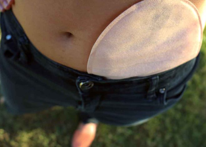 What is Ostomy? A Caregiver’s Guide
