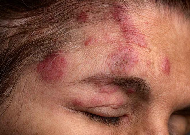 Why I Got the Shingles Vaccine As Soon as I Could